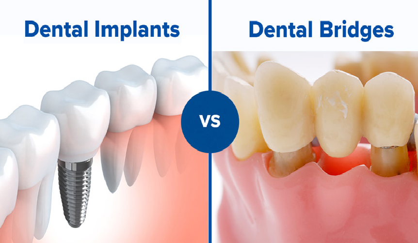 Curious Facts about The Factors That Influence The Cost Of Dental Implants