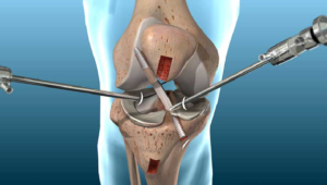 What do you mean by affordable ACL reconstruction surgery