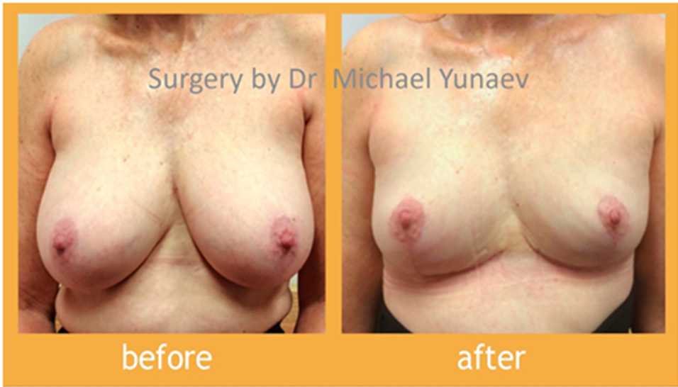 Breast Reduction