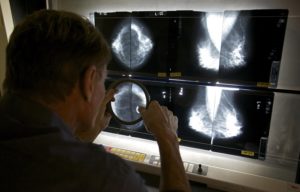 Check Whether You Have Cancer at a Breast Biopsy Center of Los Angeles