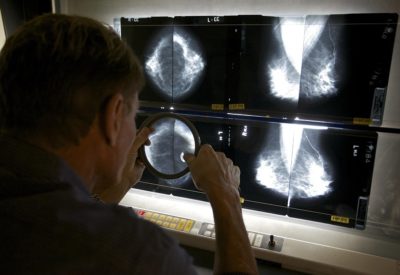 Check Whether You Have Cancer at a Breast Biopsy Center of Los Angeles