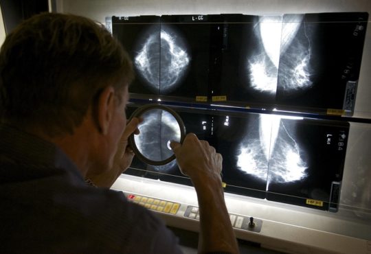 Check Whether You Have Cancer at a Breast Biopsy Center of Los Angeles