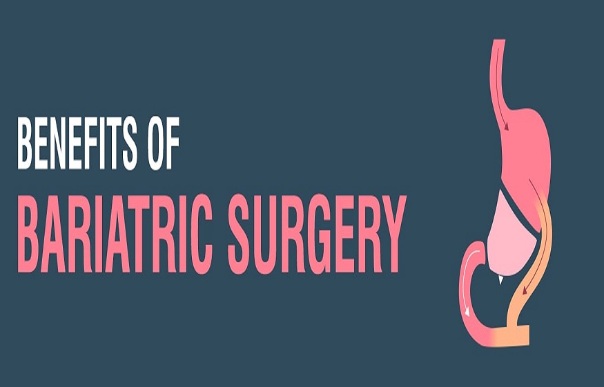 Benefits of Bariatric Surgery