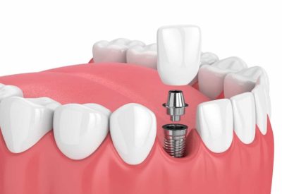 Why dental implants are getting so popular?