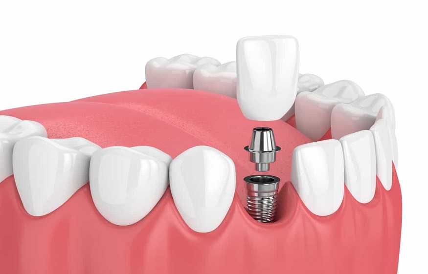 Why dental implants are getting so popular?