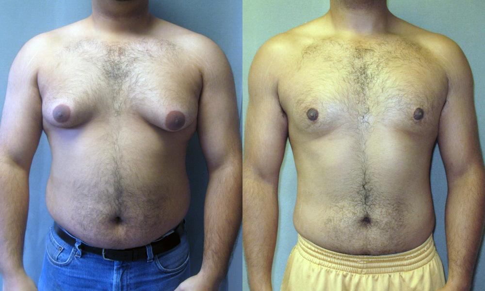 gynecomastia surgery