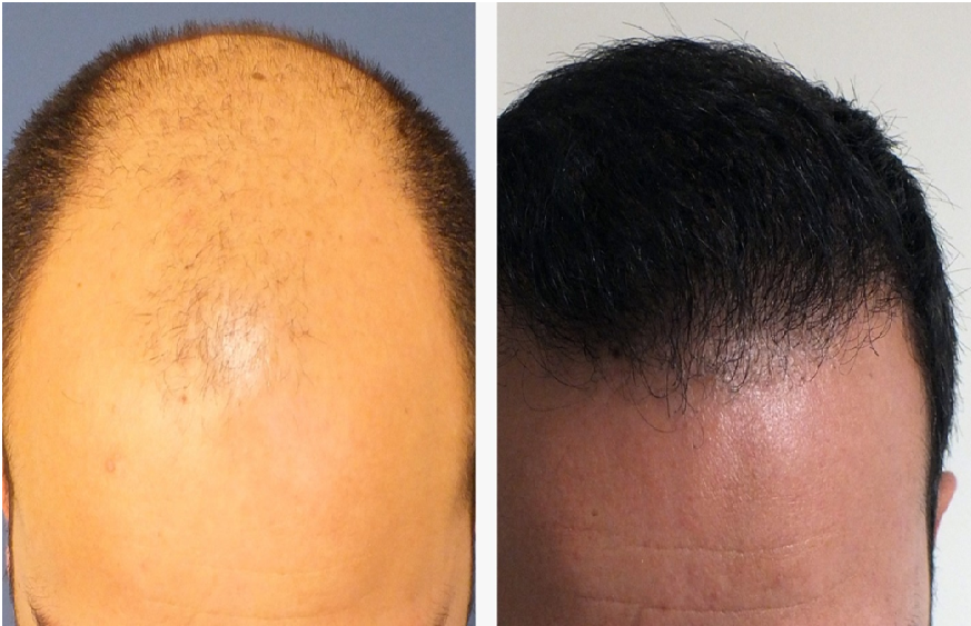 Hair Transplant in Turkey