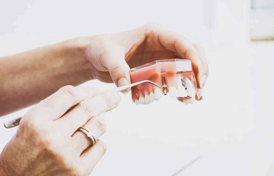 Dental implants and Invisalign