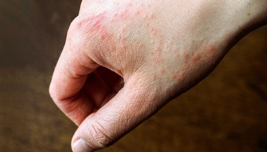 prolonged skin problem
