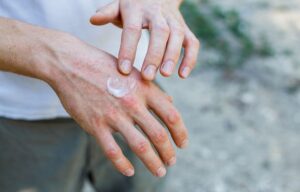 Dealing with Eczema